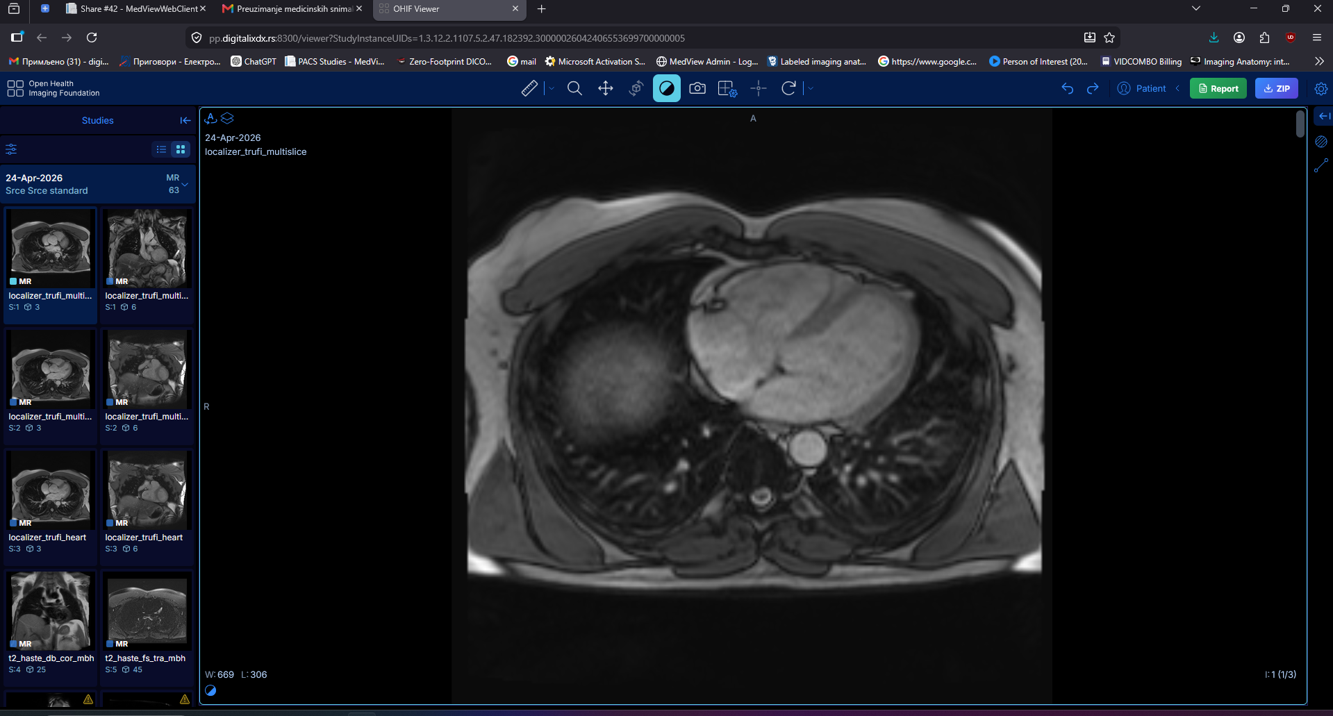 OHIF Viewer